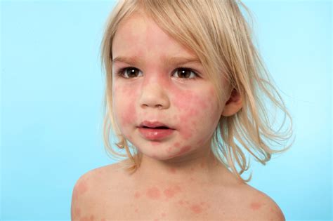 Egg allergy | Belgium| PDF | PPT| Case Reports | Symptoms | Treatment