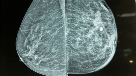 Mammogram for stage 1 breast cancer