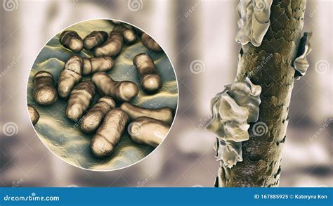 Human Hair With Dandruff And Close-up View Of Microscopic Fungi ...