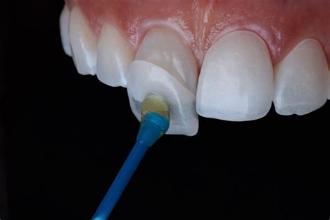 Porcelain Veneers vs. Composite Veneers - Woodbridge Hill Dental Practice