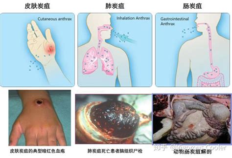 炭疽，什么来头？ - 知乎