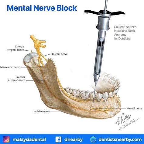 Not-so-Common Dental Blocks 👉 Akinosi Block⠀ 👉 Gow-Gates Injection Block 👉 Mental Nerve Block 👉 ...