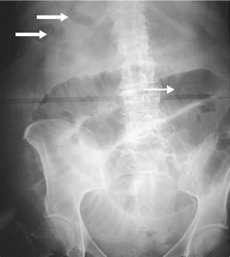 Gallstones Xray