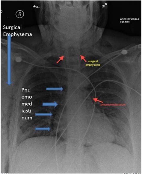 Spontaneous pneumomediastinum (Hamman's syndrome): a rare cause of postpartum chest pain | BMJ ...