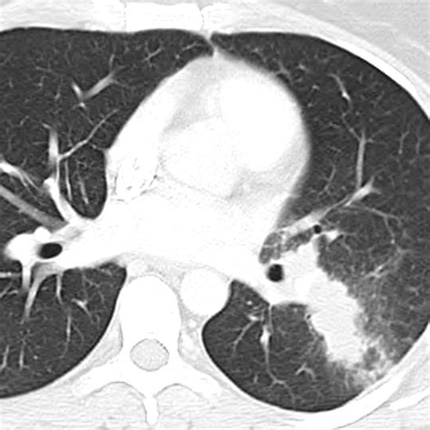 Necrotizing Granuloma of the Lung: Imaging Characteristics and Imaging ...