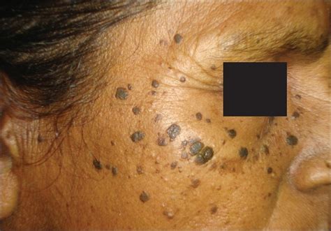 Spectrum of seborrheic keratoses in south Indians: A clinical and dermoscopic study - Indian ...