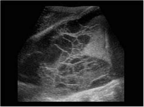 Thorax | 8.2 Pleural space : Case 8.2.1 Effusion and empyema ...