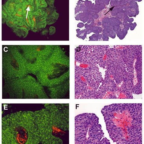 Papillary urothelial carcinoma, low grade, non-invasive | Download ...