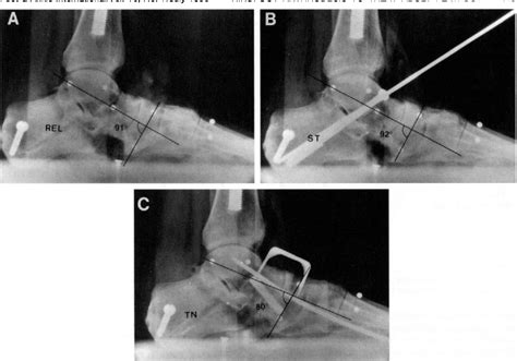 Transverse tarsal joint | Semantic Scholar