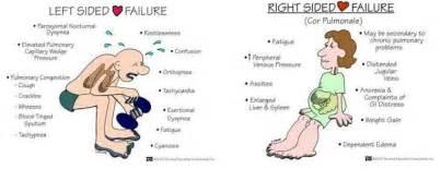 Left and right sided heart failure | nursing | Pinterest