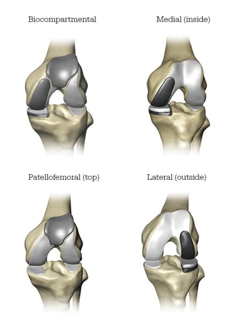 Partial Knee Replacement - WatsonvilleHospital.com