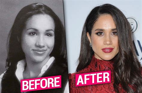 Meghan Markle Plastic Surgery & Nose Job Bombshell