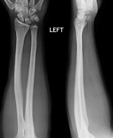 Fracture Shaft Of Radius Ulnar Bone Xray Film Stockfoto en meer beelden van Anatomie - iStock