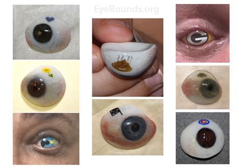 Enucleation and Evisceration: What to Expect, Fake Eyes