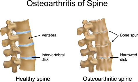 Osteoarthritis Causes, Symptoms & Treatments