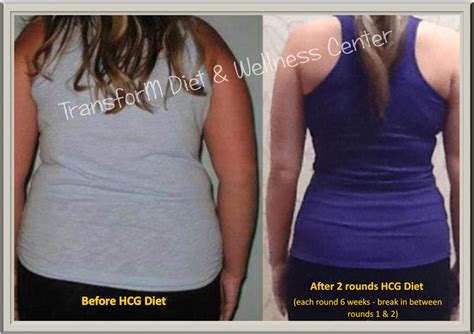 Before and After | Hcg, Hcg injections, Hcg diet injections