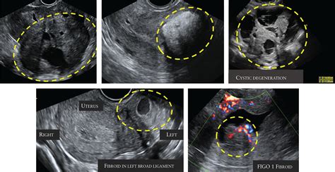 Intramural Fibroid Ultrasound