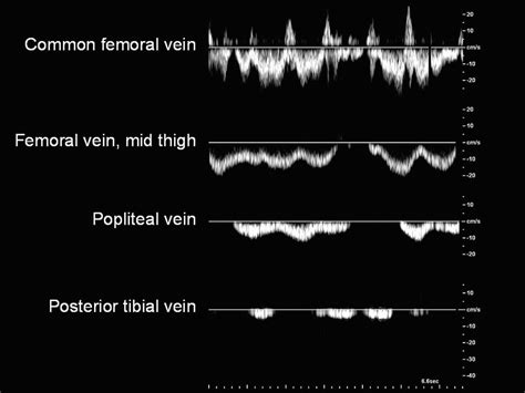 Pin by Brenda on DMU-mizzou | Vascular ultrasound, Diagnostic medical sonography, Ultrasound tech