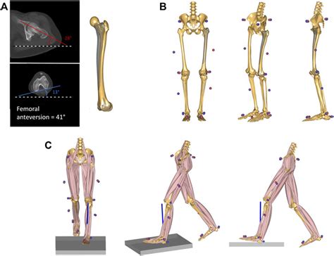 Frontiers | Increased Femoral Anteversion Does Not Lead to Increased Joint Forces During Gait in ...