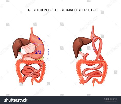 Vector Illustration Scheme Resection Stomach Billroth 스톡 벡터(로열티 프리) 1363327355 | Shutterstock