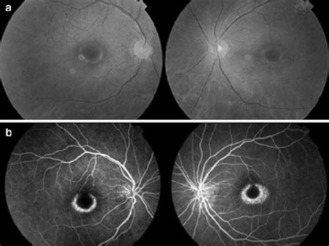 Chloroquine-induced maculopathy in its advanced stage (bull ’ s eye... | Download Scientific Diagram