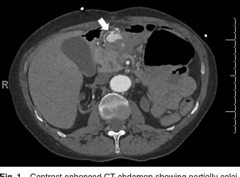 Gastroduodenal Artery Ultrasound