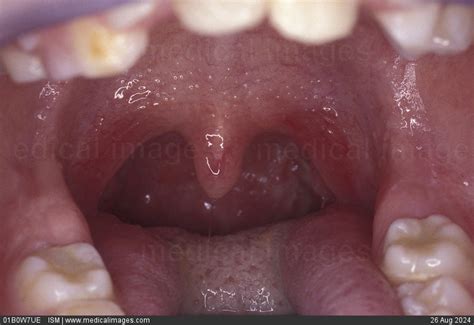 STOCK IMAGE, close-up of normal tonsils, 90494, 01B0W7UE , ISM - Search ...