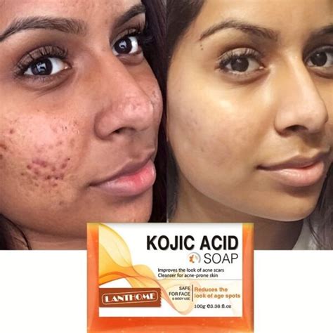 Kojic Acid Soap Before and After: Does It Really Lighten Skin? - Must Read This Before Buying