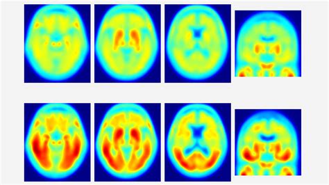 Tau protein—not amyloid—may be key driver of Alzheimer's symptoms | Science | AAAS