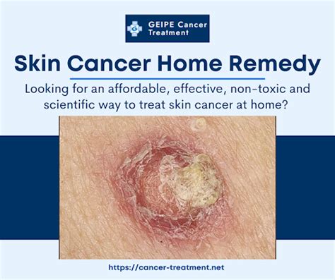 Skin Cancer Facts You Need To Know