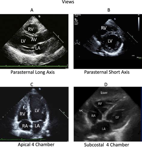 Albums 101+ Pictures Echocardiogram Pictures Of The Heart Completed