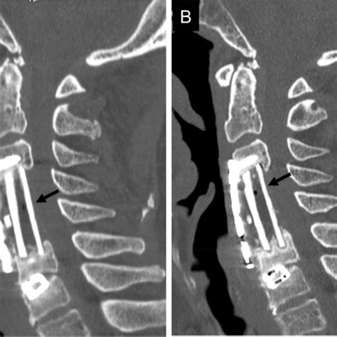 An 82-year-old man underwent anterior cervical corpectomy and fusion ...