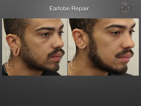 Earlobe Repair Archives - New Orleans Premier Center for Aesthetics and Plastic Surgery