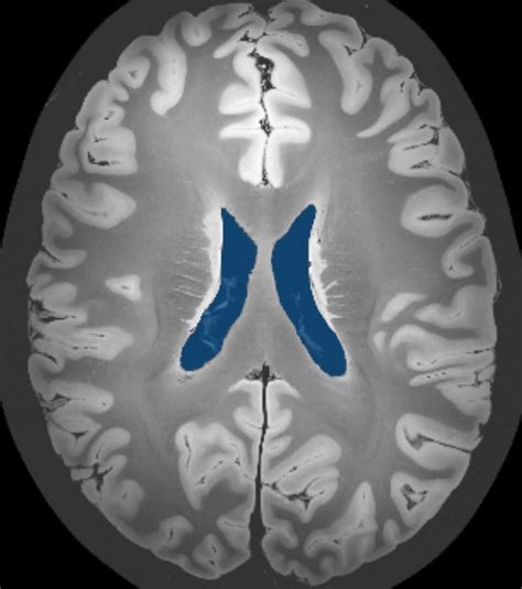 Lateral Ventricles (50 MRI cases) - MedSeg