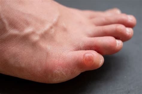 Callus on Pinky Toe after Wearing Uncomfortable Shoes. Close Up View ...