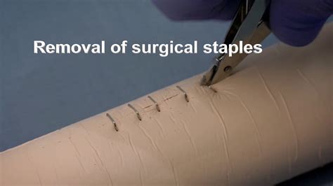 Placing and removing surgical wound closure staples - YouTube