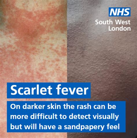 Scarlet Fever Rash Baby