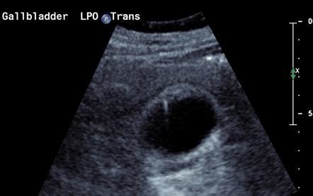 Adenomyomatosis of the gallbladder | Radiology Reference Article ...