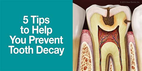 5 Tips to Help You Prevent Tooth Decay | DentalPlans Blog