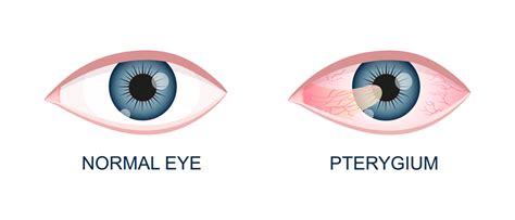 Pterygium Eye Disease