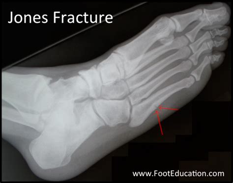 Jones Fracture - FootEducation