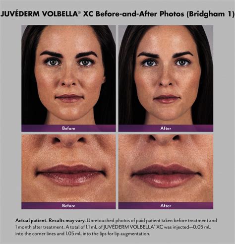 Juvederm Volbella | Deerfield Dermatology