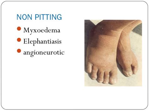 Causes of edema