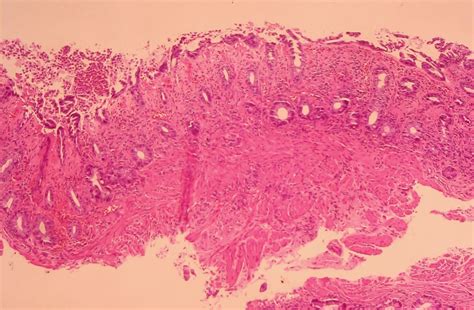 GASTROINTESTINAL AND LIVER HISTOLOGY PATHOLOGY ATLAS: COLON: ISCHEMIC ...