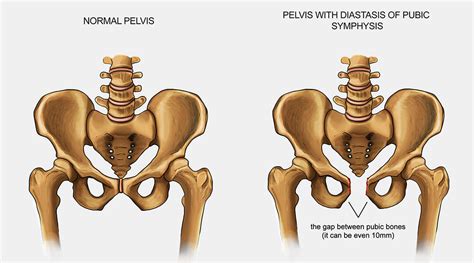 3 Ways to Decrease Pubic Symphysis Pain During Pregnancy — Heppe Chiropractic