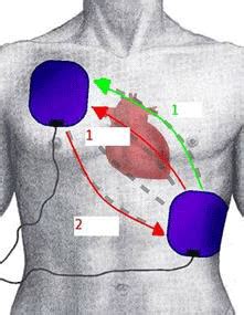 Electrical Cardioversion for Heart Rhythm Problems | HC Smart