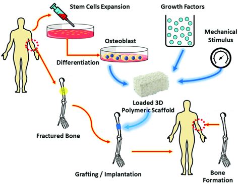 Bone tissue scaffold implantation. | Download Scientific Diagram