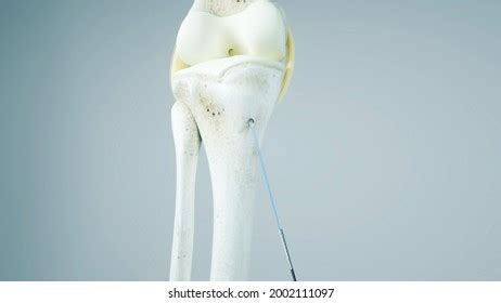 Knee Surgery Torn Tendon Repair Ligament Stock Illustration 2002111097 ...