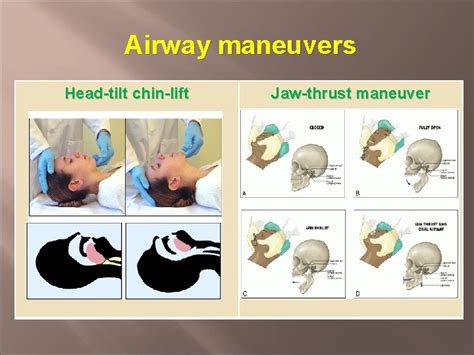 Head Tilt Chin Lift Maneuver Vs Jaw Thrust