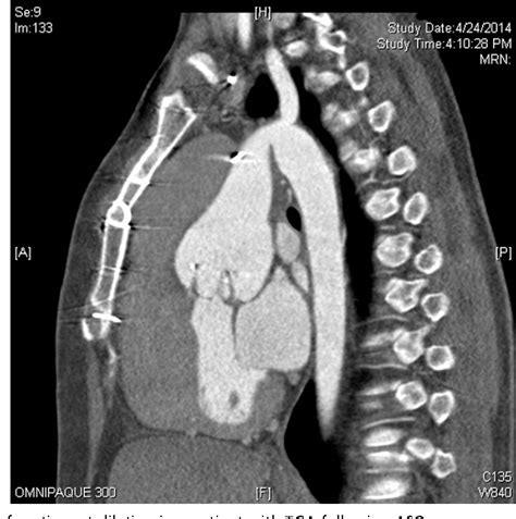 Figure 1 from Dextro-Transposition of the Great Arteries: Long-term ...